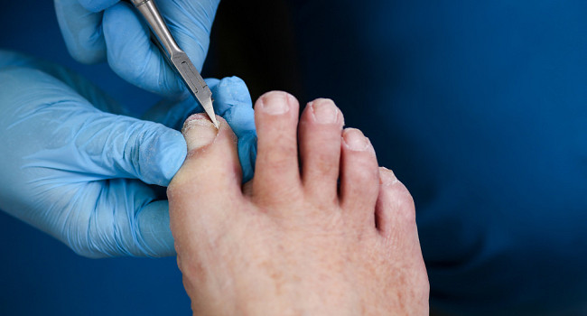 Протезирование ногтя Санкт-Петербург - изображение 2