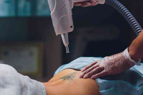 Лазерное удаление татуировки Санкт-Петербург