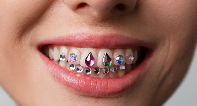 Зубные украшения Санкт-Петербург - изображение 3