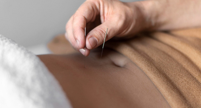 Иглоукалывание в медицинском центре «Два крыла» Санкт-Петербург - изображение 3