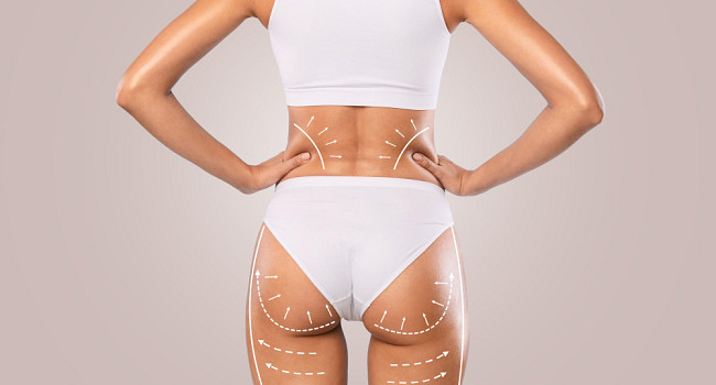 Пластика ягодиц (глютеопластика) Санкт-Петербург - изображение 2